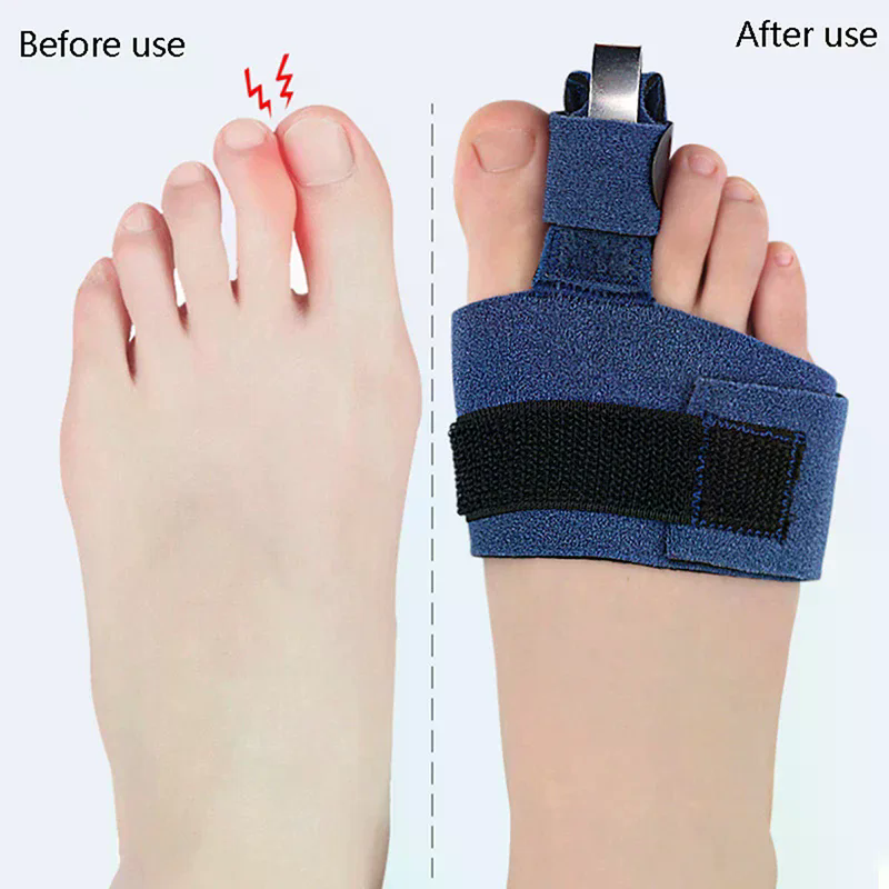 1Pcs Toe Corrector Toe Fractur - Ankle Brace Sock recensie en prijs